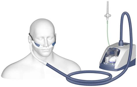 High Flow Nasal Cannula Oxygen Therapy As An Emerging Option For Respiratory Failure The