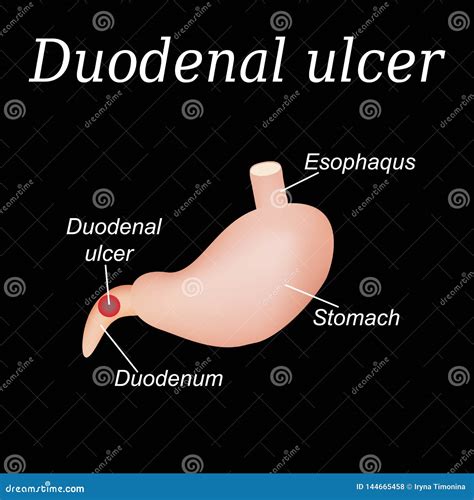 Duodenum Ulcer Affected Duodenal Ulcer Vector Illustration On A Background Of Isolation