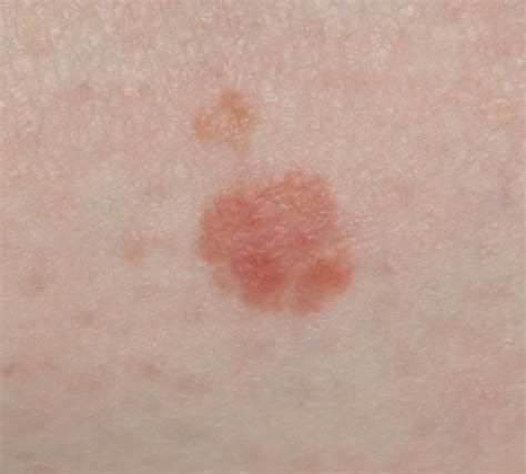 Gallery For Skin Cancer Pictures