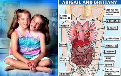 Abigail And Brittany Hensel Anatomy
