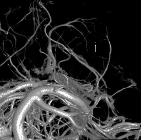 Angiography — Thalamic Hemorrhage Spot Sign