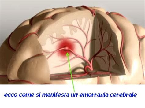 Ruolo della neuroradiologia nell'emorragia cerebrale. Emorragia cerebrale