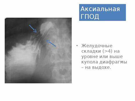 Диета для грыжи диафрагмы Грыжи пищеводного отверстия диафрагмы Грыжи пищеводного отверстия диафрагмы Диета для грыжи диафрагмы
