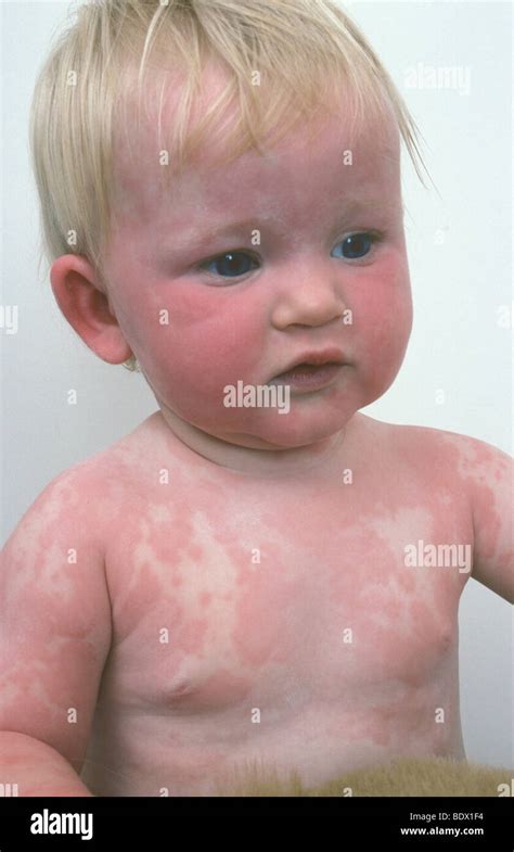 Kind Mit Viraler Hautausschlag Im Gesicht Und Körper Stockfotografie