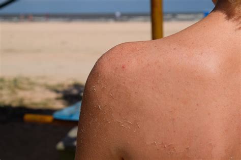 How Bad Of A Sunburn Causes Cancer Cancerwalls