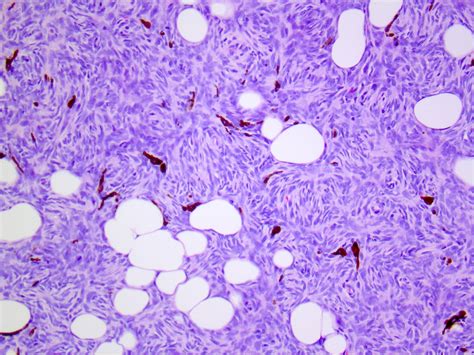 Dermatofibrosarcoma Protuberans Histology