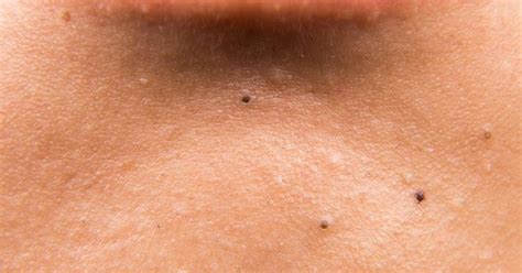 How To Reduce Black Spots On The Face Livestrongcom