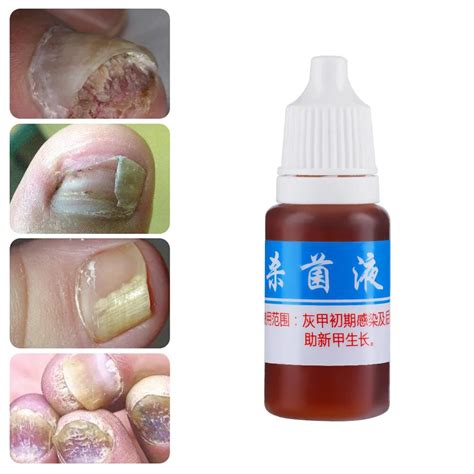 1 Bottle Fungal Nail Treatment Liquid Bright Nail Repair Onychomycosis
