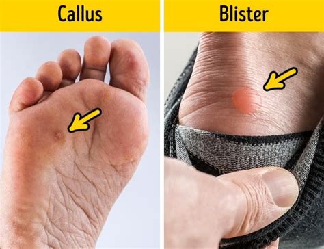 11 Ingenious Ways To Get Rid Of Blisters And Callus Overnight Get Rid