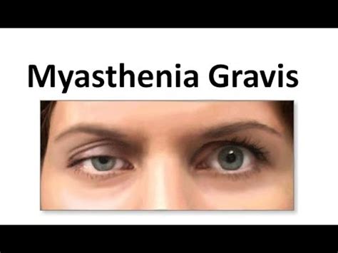 Outside of japan, remdesivir is an investigational, unapproved drug. Myasthenia Gravis - YouTube