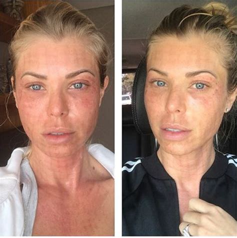 Caroline Bittencourt fala sobre o dolorido procedimento de laser com