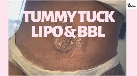 Tummy Tuck Lipo And Bbl At Home Care And Recovery After Tt And Brazilian