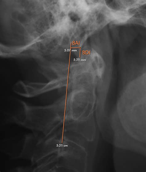 Radiographic Evaluation Of The Upper Cervical Spine Radiology Key