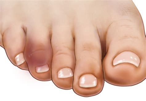 Broken Toe — What To Do For Treatment