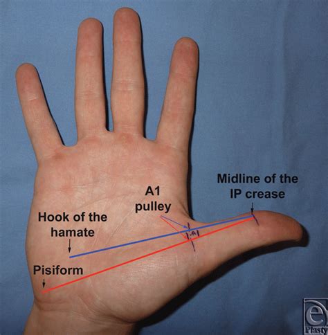 Safe Treatment Of Trigger Thumb With Longitudinal Anatomic Landmarks