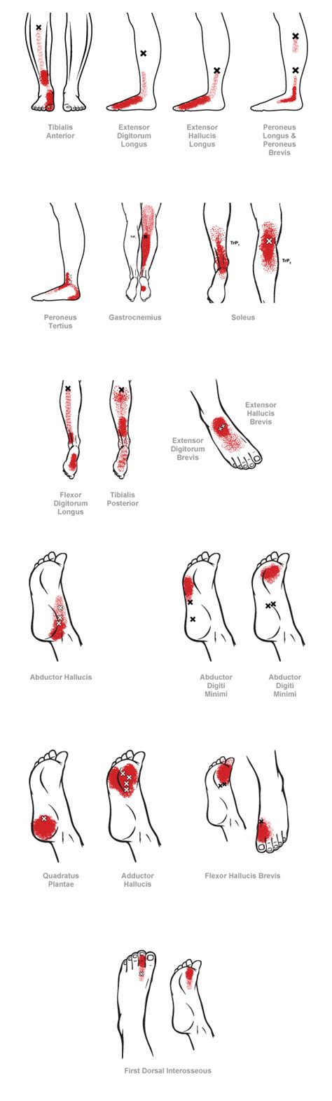 Ankle And Foot Myofascial Pain Syndrome Muscle Pain