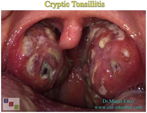 Cryptic Tonsillitis Causes Symptoms And Treatment