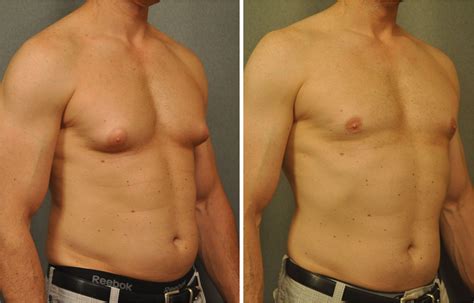 Liposuction For Men S Chest Distaffen