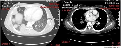 Embolia Pulmonar Tumoral Un Reto Diagnóstico Revista Colombiana De