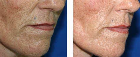Wrinkle Removal Treatment Velashape London Clinic