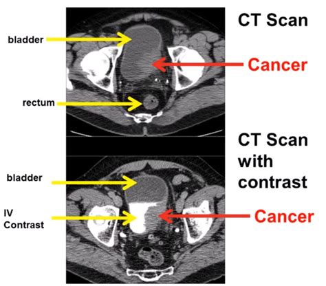 Does A Ct Scan Detect Bladder Cancer Updated