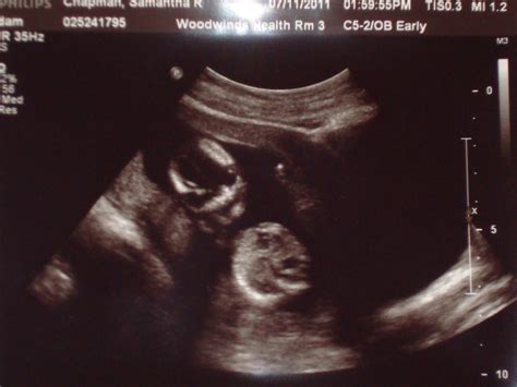 Note, however, that they still may be hard to detect on an ultrasound. Real Life: A MN Mom: 14 weeks 5 days pregnant ...