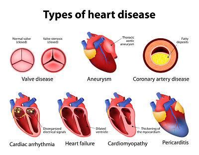 Miocardiopatía restrictiva causas síntomas y tratamiento