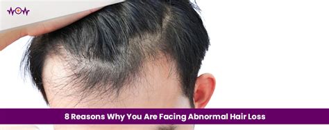 Reasons Why You Are Facing Abnormal Hair Loss Wow Health Pkaistan