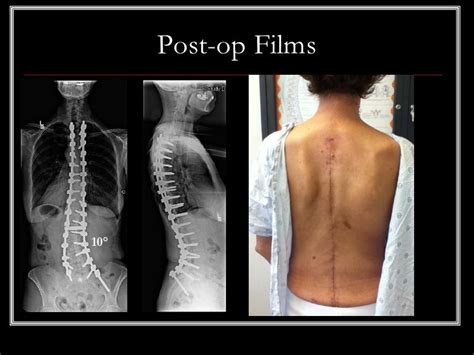 Case Review 51 59 Year Old Female With Collapsing Scoliosis