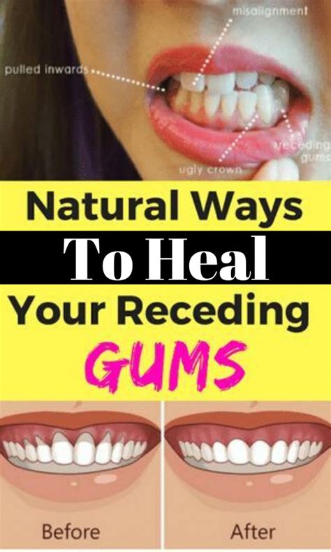 9 Easy Ways To Heal Receding Gums Naturally In 2020 Receding Gums