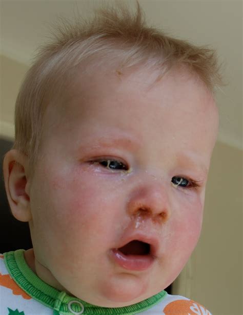 Pinkeye In Babies Pictures Photos