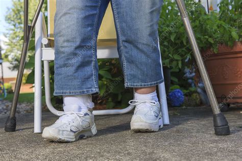 Woman With New Leg Brace And Crutches Stock Image F0124437
