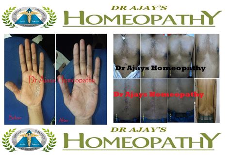 Dr Ajays Homeopathy Psoriasis Is Curable With Homeopathy