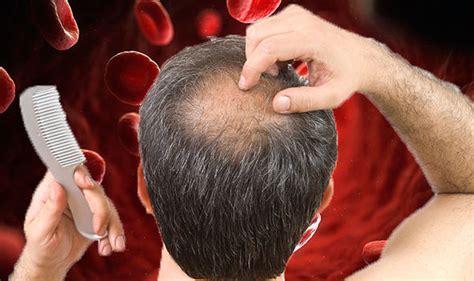 Iron Deficiency Anaemia Hair Loss Could Be A Sign Of The Condition
