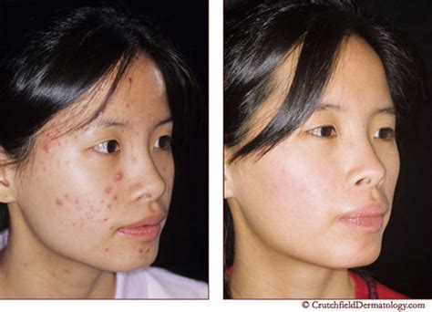 Acne Laser Treatment On Asian Teenage Girl Before And After A Photo On