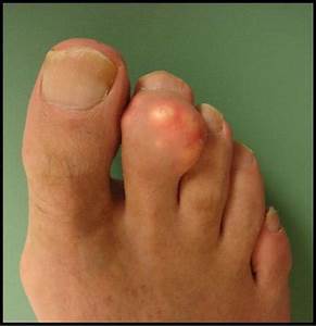 What is gout? AL doctor explains Gout  