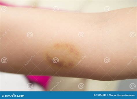 Bruise On Upper Arm