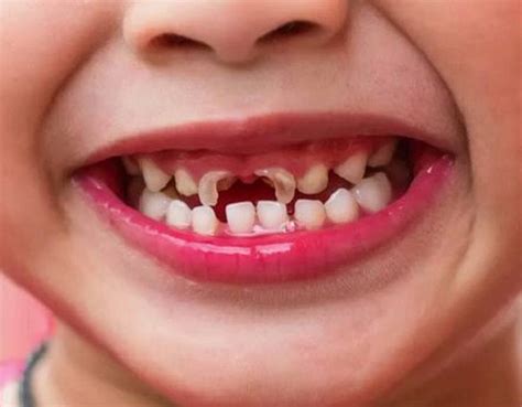 Is It Common To Have A Cavity In Kids Sabka Dentist Top Dental