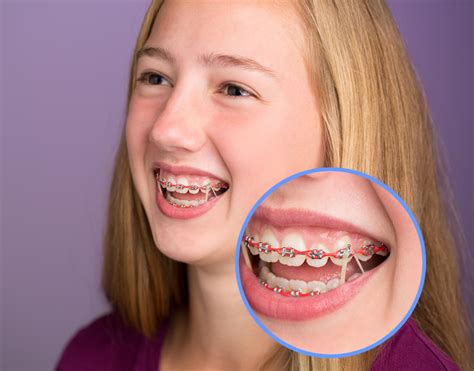 Use dental floss to ease out any gum left in your braces. Orthodontic Appliances Monmouth Ocean County NJ - Holmdel ...