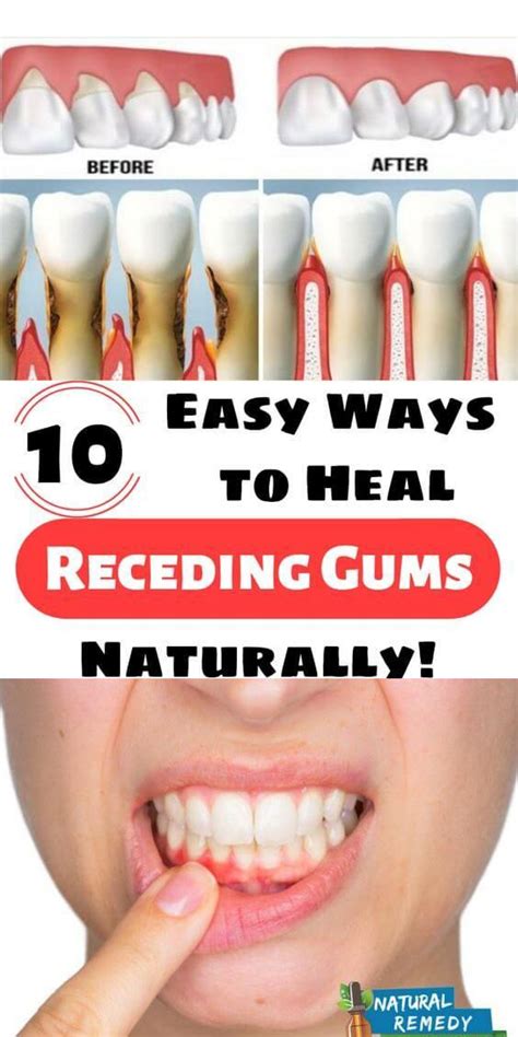 10 Easy Ways To Heal Receding Gums Naturally Receding Gums Natural