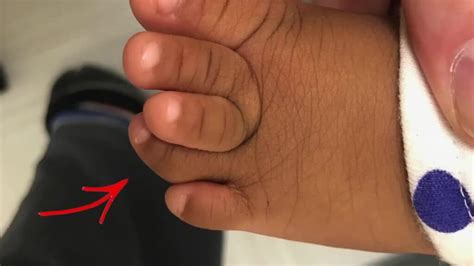 Pediatric Hammertoes Curly Toes Causes And Treatments