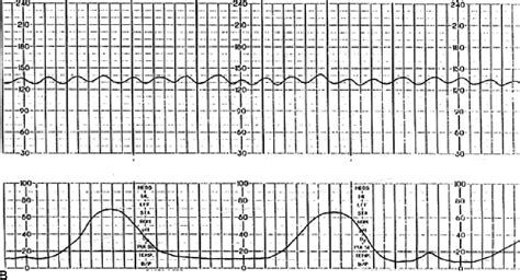 Figure 11 From Interpretation Of The Electronic Fetal Heart Rate During