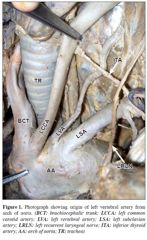Anatomy Of Vertebral Artery