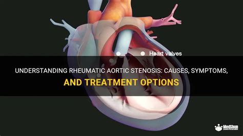 Understanding Rheumatic Aortic Stenosis Causes Symptoms And Treatment Options Medshun