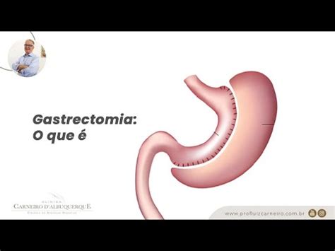 Gastrectomia o que é Prof Dr Luiz Carneiro CRM 22761 YouTube