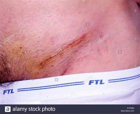 Inguinal Hernia High Resolution Stock Photography And Images Alamy