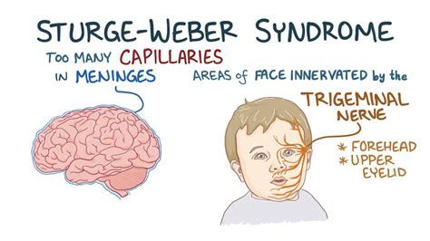 Sturge Weber Syndrome Video Anatomy And Definition Osmosis