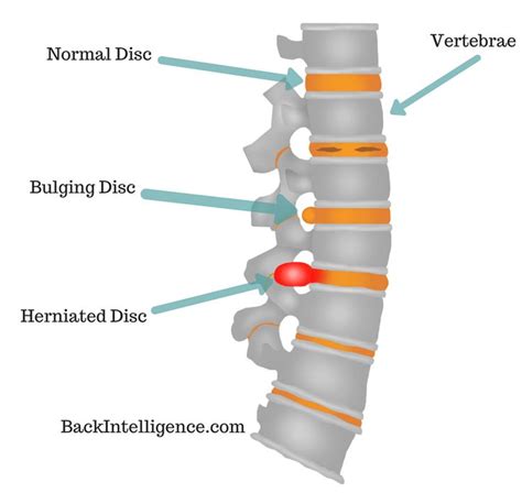 7 Herniated Disc Exercises For Lower Back Lumbar Area Herniated