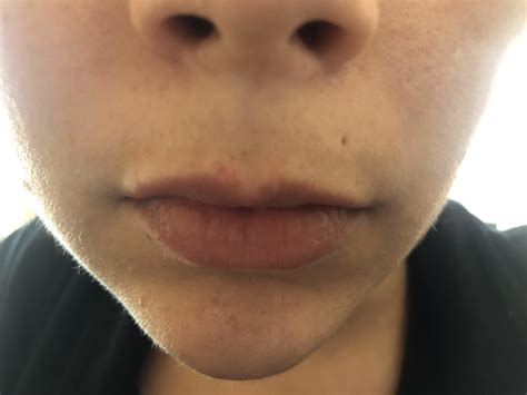 Skin Concerns My Top Lip Skin Is Slowly Disappearing I Get Red Or White Spots On My Lips For