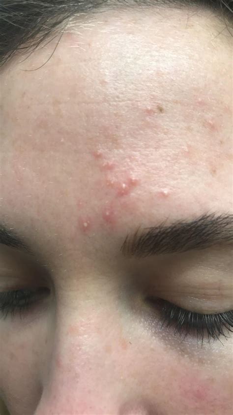 Getting Random Clusters Of Acne On My Forehead But Other Areas Are